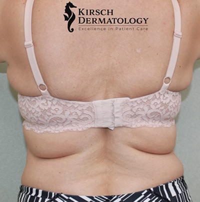 Before and After Photos of Naples Woman who had BBL in addition to Breast  Augmentation and Tummy Tuck